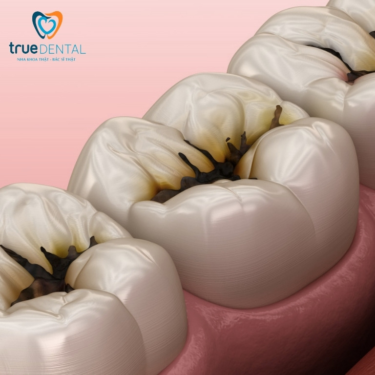 Răng có vết đen: Nguyên nhân, cách chữa trị và phòng ngừa 8 Vết đen trên răng hàm