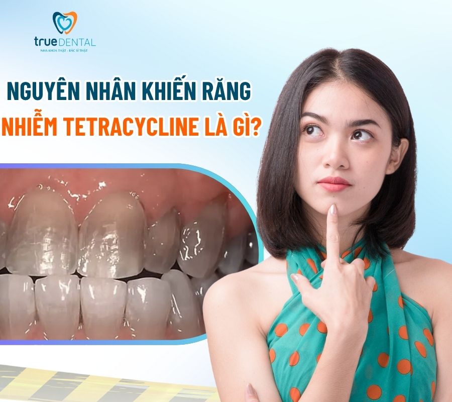 Răng nhiễm Tetracycline là gì? Nguyên nhân và cách điều trị 3 Nguyên nhân khiến răng nhiễm Tetracycline
