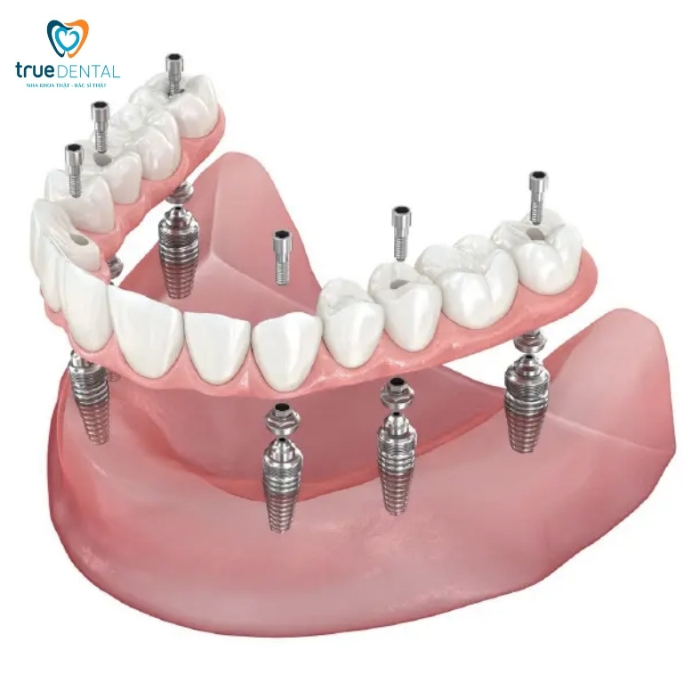 Trồng răng Implant All on 6: Quy trình, chi phí và lưu ý cần biết 1 Trồng răng Implant All on 6 là gì?
