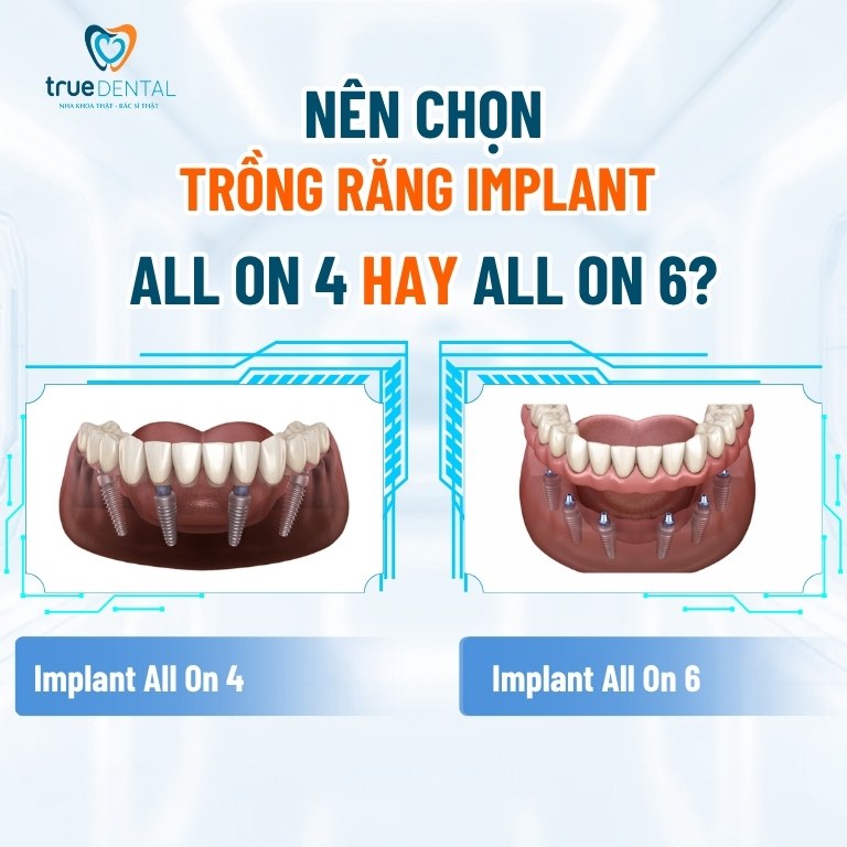 Trồng răng Implant All on 6: Quy trình, chi phí và lưu ý cần biết 5 Nên chọn trồng răng Implant All on 4 hay All on 6?