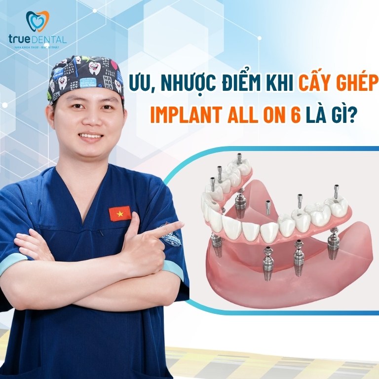 Trồng răng Implant All on 6: Quy trình, chi phí và lưu ý cần biết 2 Ưu nhược điểm của phương pháp trồng răng Implant All on 6