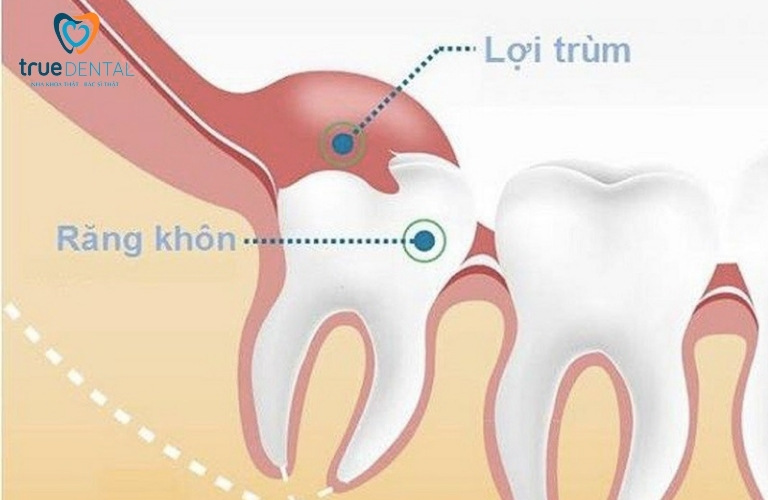 Viêm lợi răng khôn có tự khỏi không? Điều trị như thế nào? 1 Viêm lợi răng khôn là gì?