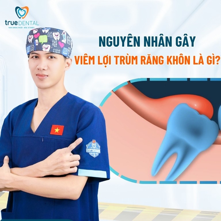 Viêm lợi răng khôn có tự khỏi không? Điều trị như thế nào? 2 Nguyên nhân viêm lợi trùm răng khôn