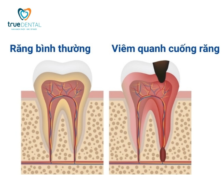 Viêm quanh cuống răng: Nguyên nhân và cách chữa trị 1 Viêm quanh cuống răng là gì?