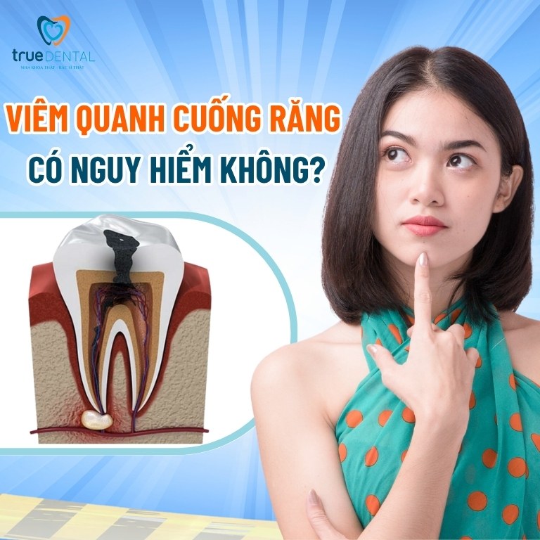 Viêm quanh cuống răng: Nguyên nhân và cách chữa trị 5 Viêm quanh cuống răng có nguy hiểm không?