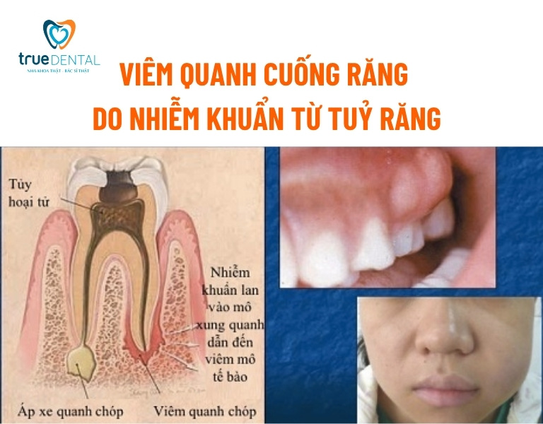 Viêm quanh cuống răng: Nguyên nhân và cách chữa trị 3 Nguyên nhân gây viêm quanh cuống răng