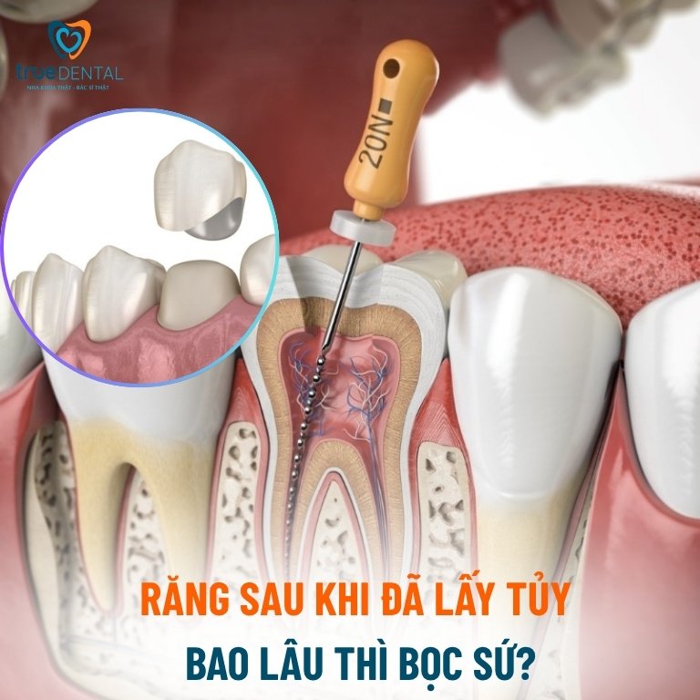 Có nên bọc răng sứ sau khi lấy tủy? 2 Răng sau khi đã lấy tủy bao lâu thì bọc sứ?