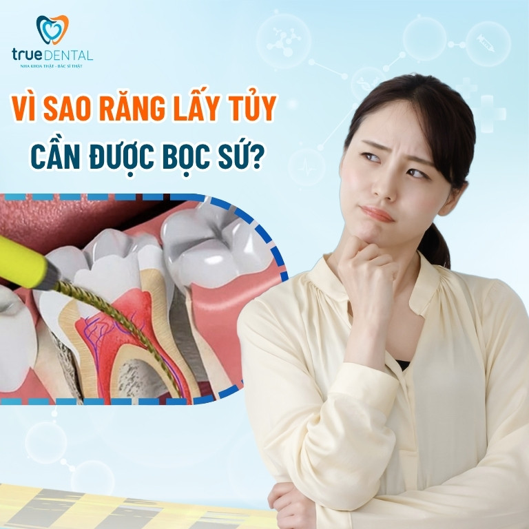 Có nên bọc răng sứ sau khi lấy tủy? 3 Vì sao răng lấy tủy cần được bọc sứ?