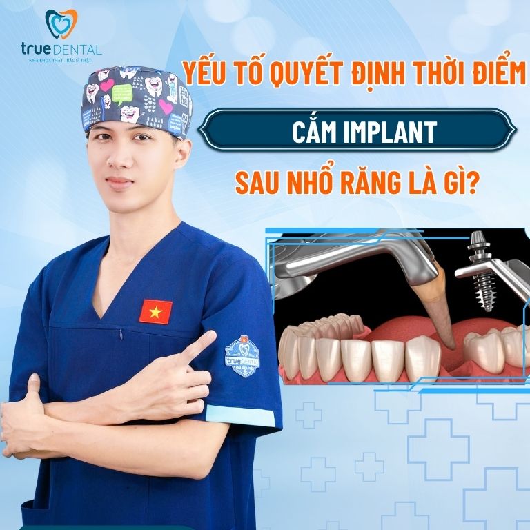 Có nên cấy ghép Implant sau khi nhổ răng? 4 Yếu tố quyết định thời điểm cắm Implant sau nhổ răng