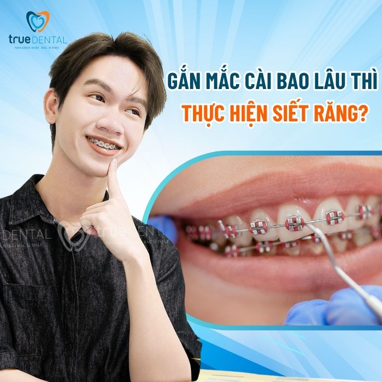 Gắn mắc cài bao lâu thì nên thực hiện siết răng? 2 Gắn mắc cài bao lâu thì nên thực hiện siết răng?