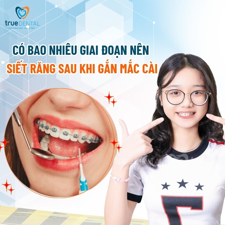 Gắn mắc cài bao lâu thì nên thực hiện siết răng? 3 Từng giai đoạn nên siết răng sau khi gắn mắc cài