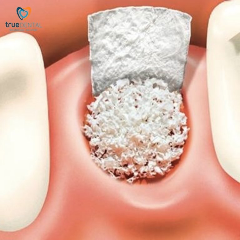 Ghép Xương Implant Là Gì? Có Đau Không? Chi Phí Bao Nhiêu? 4 Các loại màng xương sử dụng trong cấy ghép xương Implant