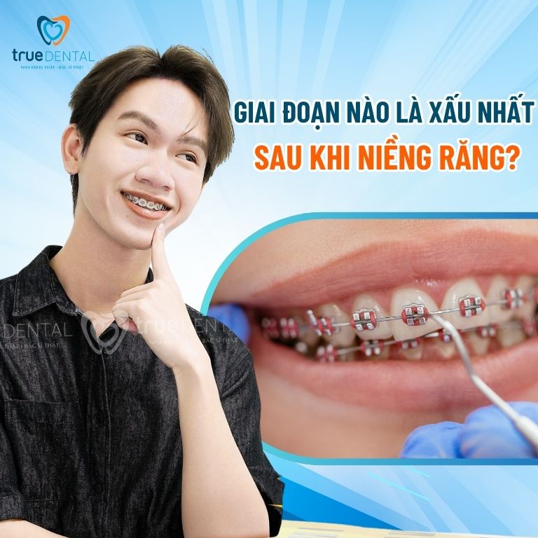 Giai đoạn nào là xấu nhất sau khi niềng răng? 2 Giai đoạn nào là xấu nhất sau khi niềng răng?