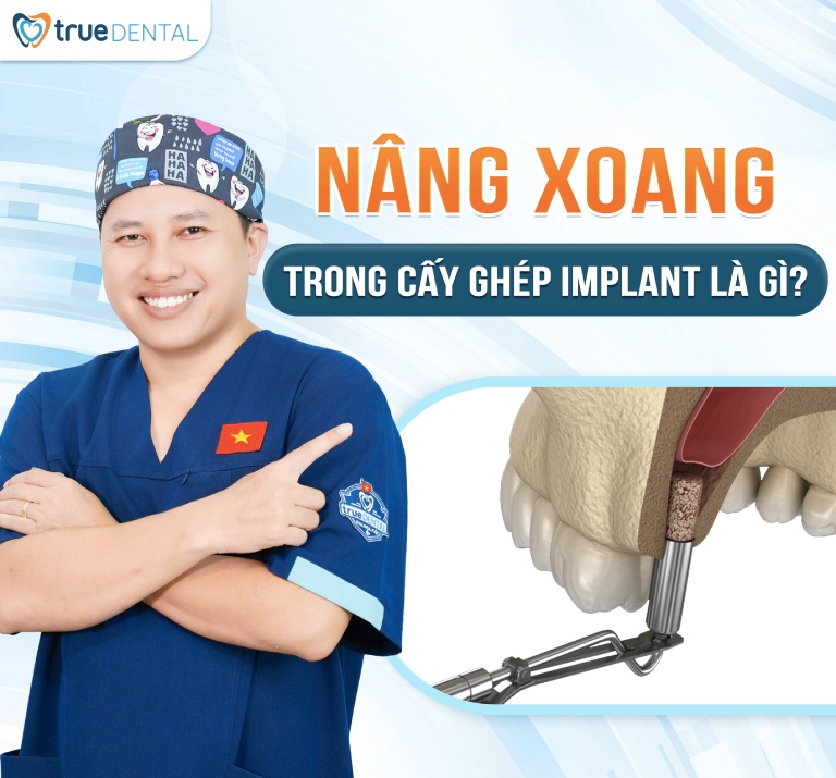 Kỹ thuật nâng xoang hàm trong cấy ghép răng Implant 1 Nâng xoang hàm trong cấy ghép răng Implant là gì?