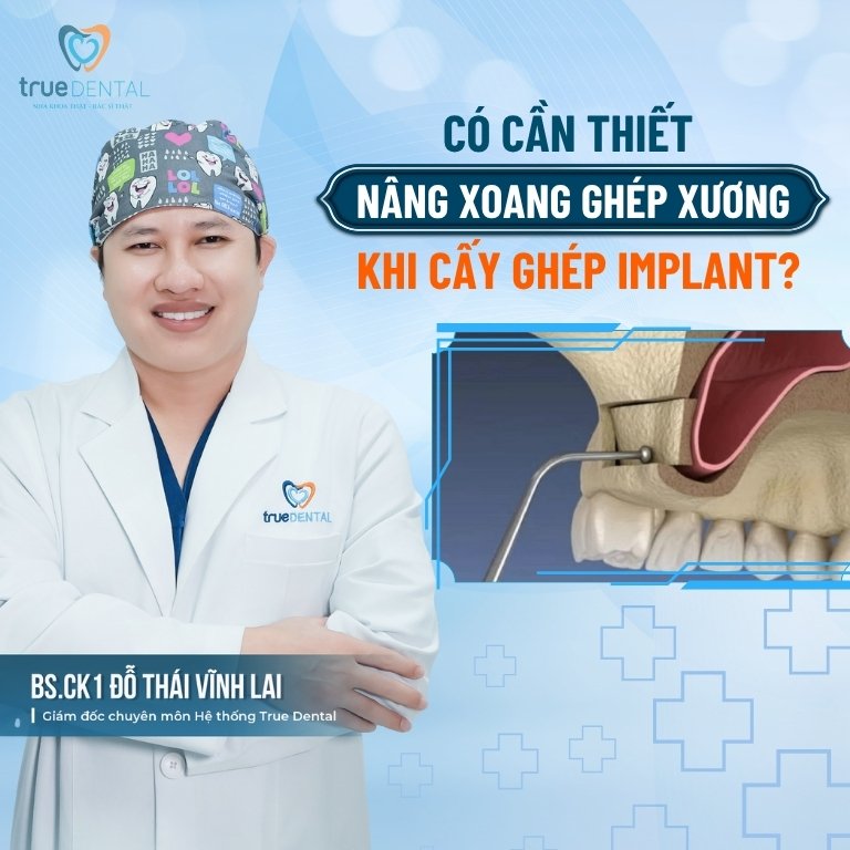 Kỹ thuật nâng xoang hàm trong cấy ghép răng Implant 4 Có cần thiết phải nâng xoang ghép xương khi cấy ghép Implant?