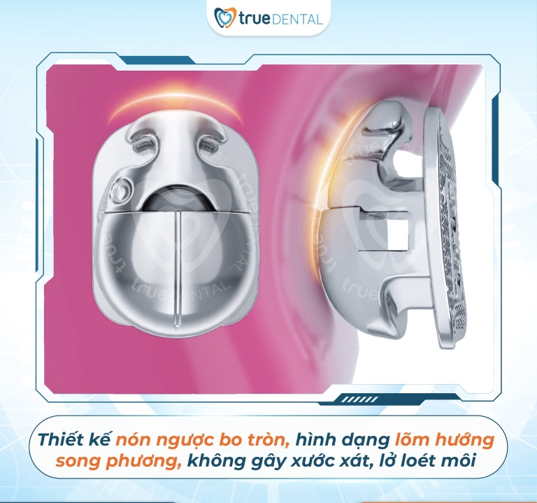 Giải Mã Mắc Cài Cánh Cam Cải Tiến: Có Nên Niềng Không? 2 Ưu điểm của mắc cài cánh cam bản cải tiến