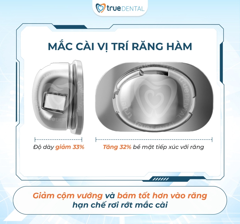 Giải Mã Mắc Cài Cánh Cam Cải Tiến: Có Nên Niềng Không? 3 ưu điểm đặc biệt của mắc cài cánh cam bản cải tiến