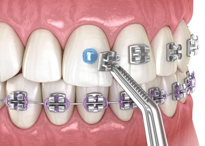 Niềng răng mắc cài được gắn vào răng như thế nào? 1 Khái niệm niềng răng mắc cài là gì?