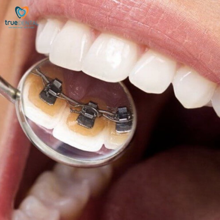 Niềng răng mắc cài mặt trong dành cho trường hợp nào? 5 Quy trình niềng răng mắc cài mặt trong