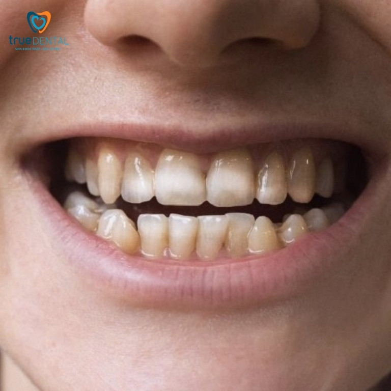 Răng bị mòn có nên bọc sứ? 1 Răng bị mòn