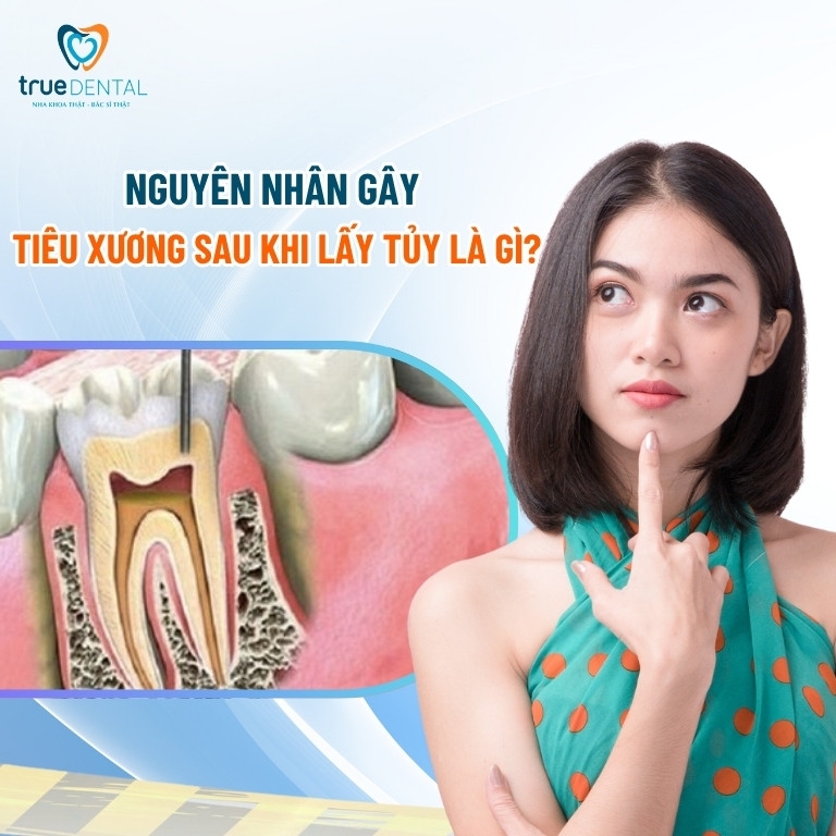 Răng lấy tủy có bị tiêu xương không? 4 Nguyên nhân gây tiêu xương sau khi lấy tủy