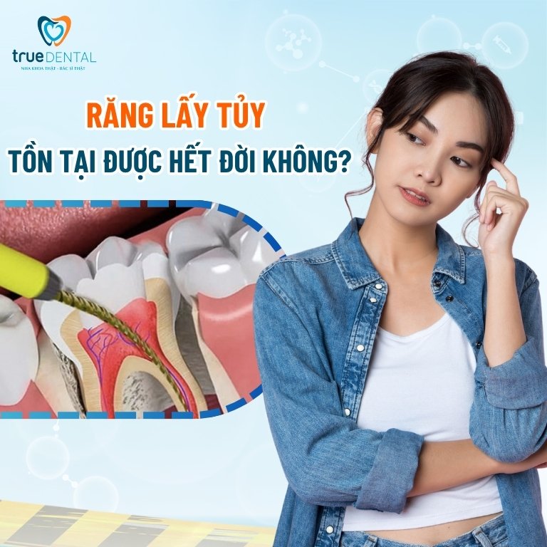 Răng lấy tủy có tồn tại được hết đời 2 Răng lấy tủy tồn tại được hết đời không?