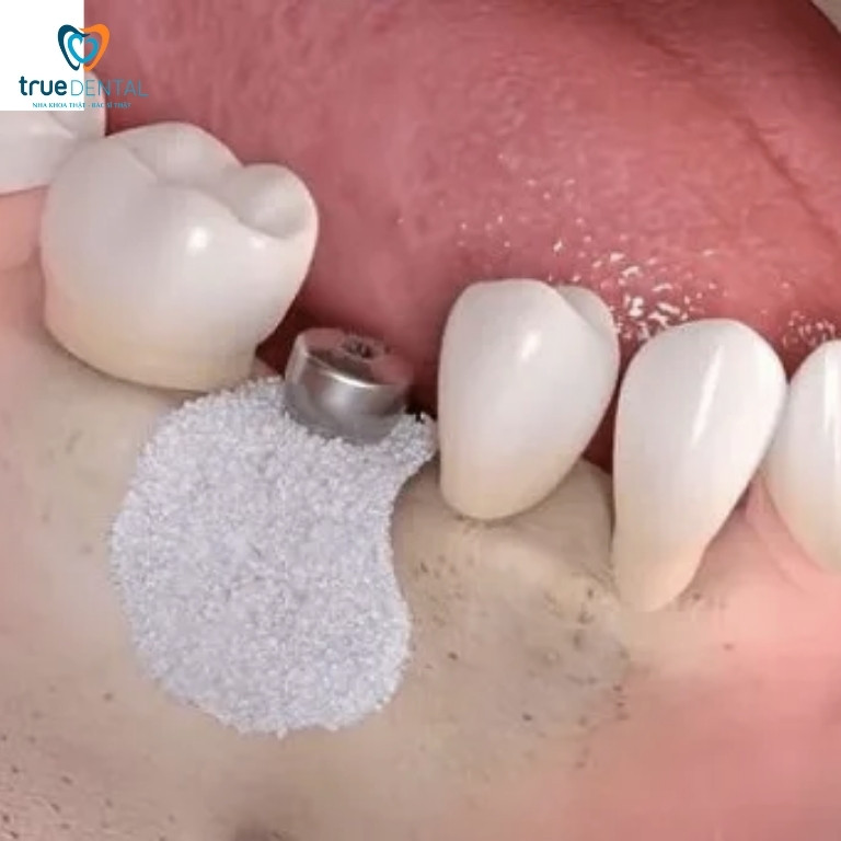 Những rủi ro có thể gặp khi cấy ghép Implant 3 Tiêu xương quanh trụ