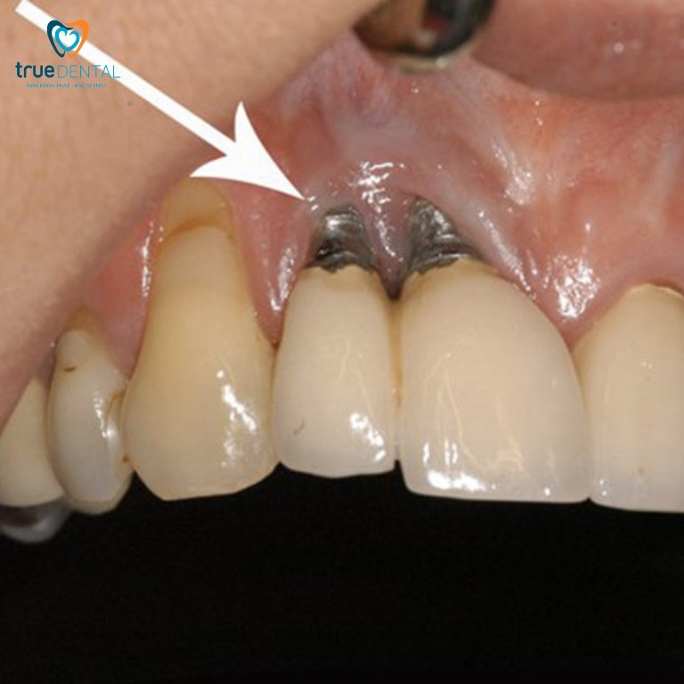 Những rủi ro có thể gặp khi cấy ghép Implant 2 Ảnh hưởng mô mềm xung quanh
