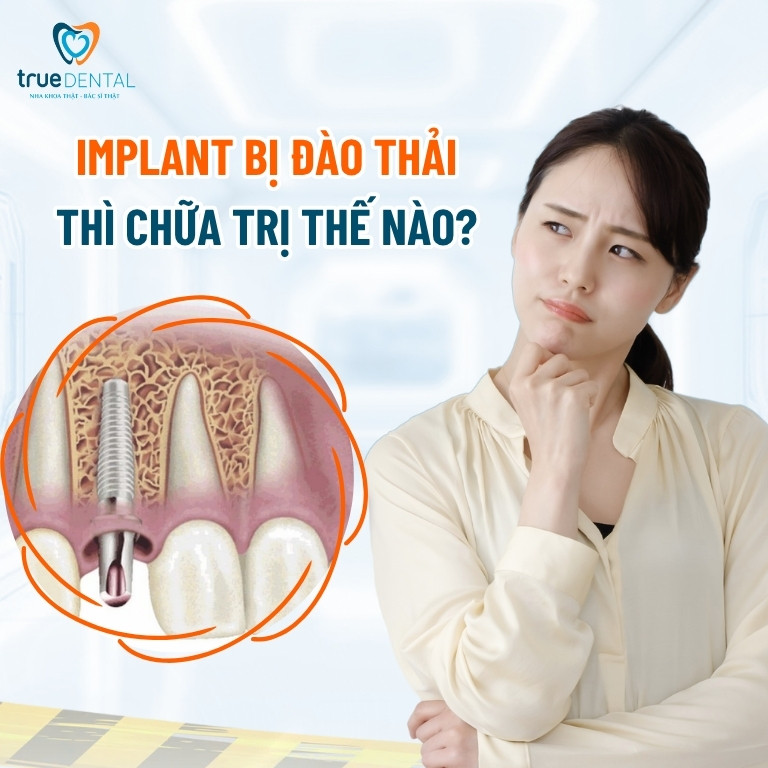 Nếu Implant bị đào thải thì chữa trị thế nào?