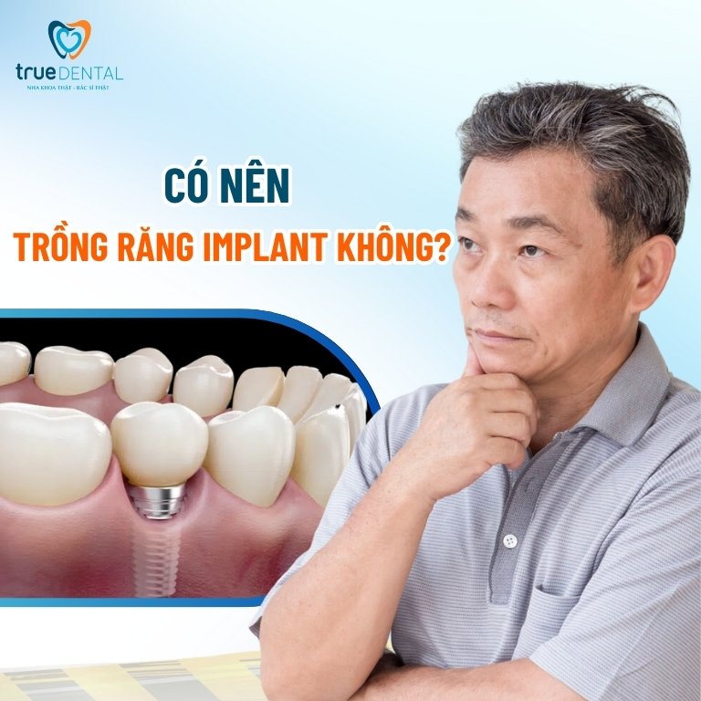 Có nên trồng răng Implant không?