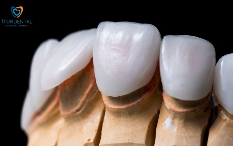 Các loại mặt dán sứ Veneer có tại True Dental
