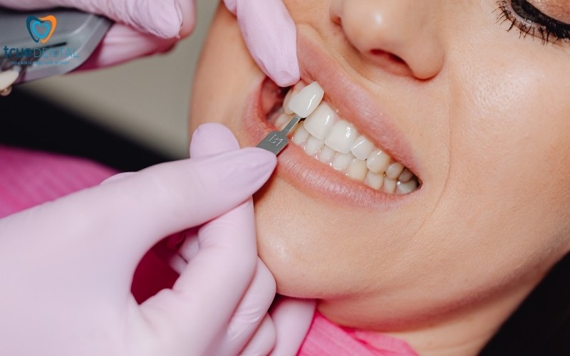 Các loại mặt dán sứ Veneer có tại True Dental