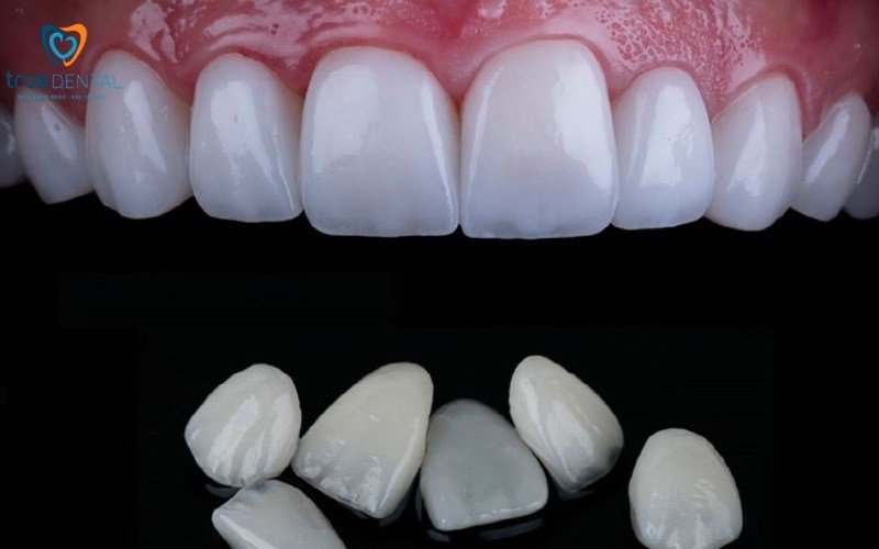Các loại mặt dán sứ Veneer có tại True Dental