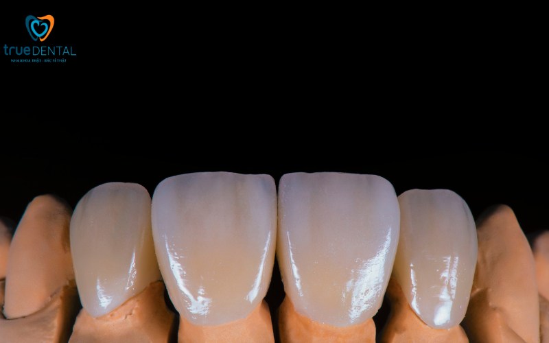 Các loại mặt dán sứ Veneer có tại True Dental