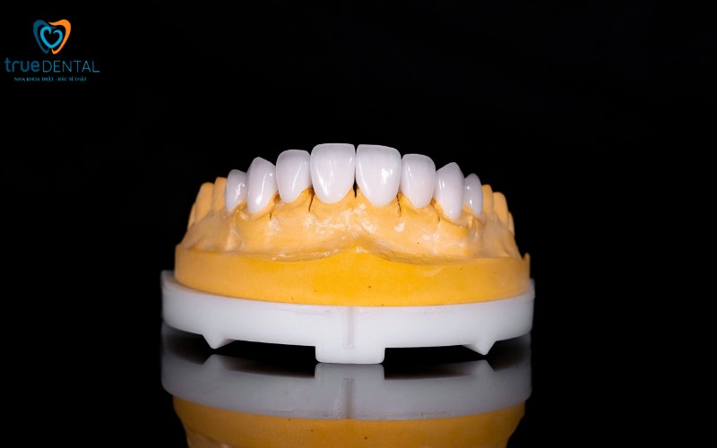 Các loại mặt dán sứ Veneer có tại True Dental