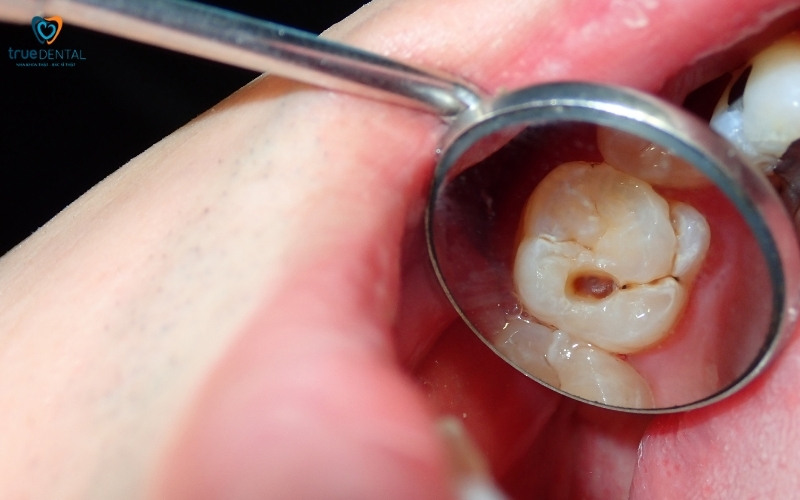 Các vấn đề về răng miệng thường gặp 1 Các vấn đề về răng miệng