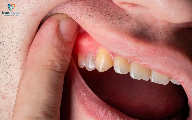 Các vấn đề về răng miệng thường gặp 2 Các vấn đề về răng miệng