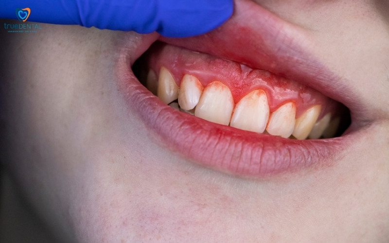 Các vấn đề về răng miệng thường gặp 3 Các vấn đề về răng miệng