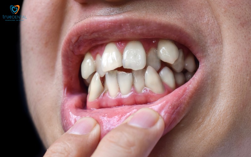 Các vấn đề về răng miệng thường gặp 6 Các vấn đề về răng miệng