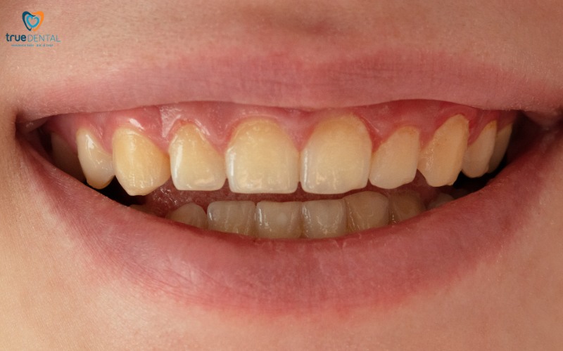 Các vấn đề về răng miệng thường gặp 7 Các vấn đề về răng miệng