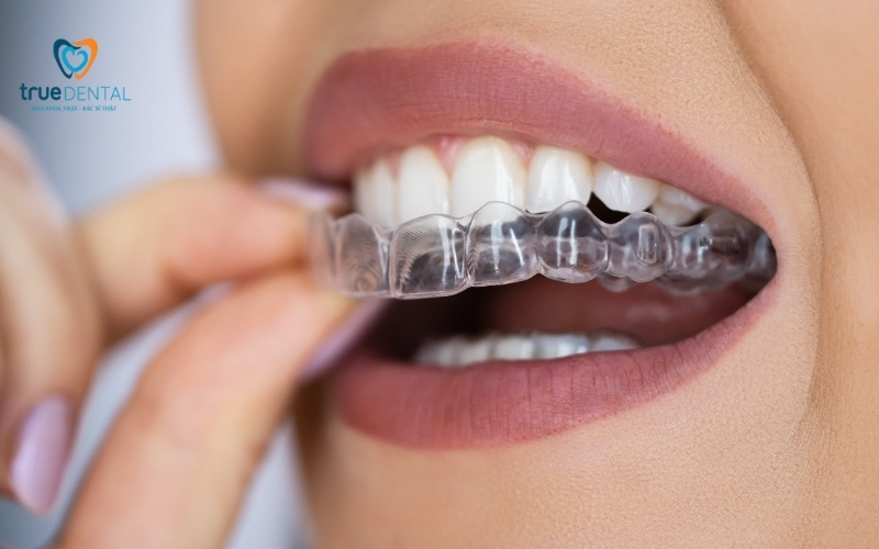 Chăm sóc răng sứ thẩm mỹ đúng cách tránh hư hại cho răng 2 Chăm sóc răng sứ thẩm mỹ đúng cách