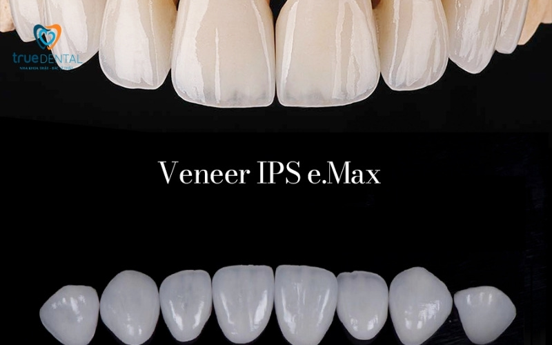 Chất liệu mặt dán sứ Veneer - Dán sứ Veneer tại True Dental 3 Chất liệu mặt dán sứ Veneer