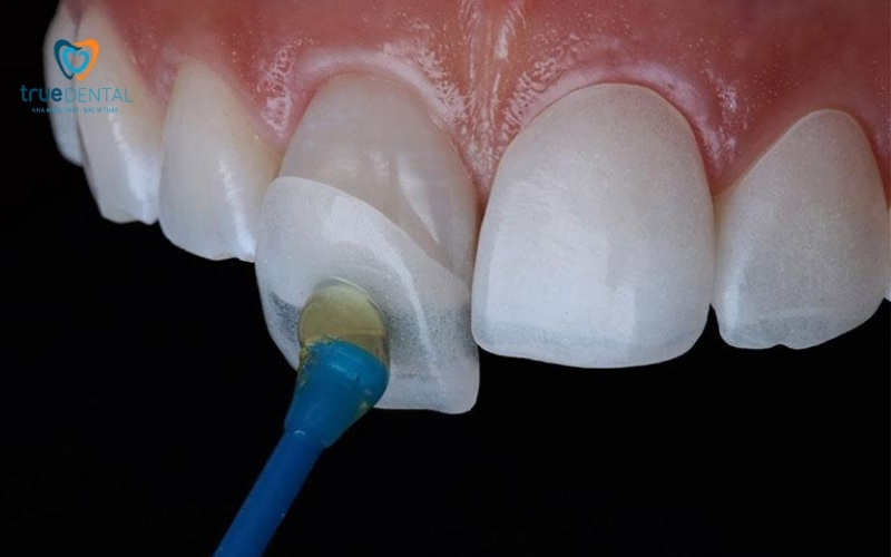 Chất liệu mặt dán sứ Veneer - Dán sứ Veneer tại True Dental 4 Chất liệu mặt dán sứ Veneer