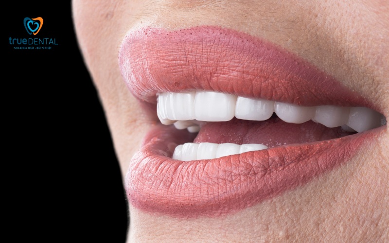 Chất liệu mặt dán sứ Veneer - Dán sứ Veneer tại True Dental 5 Chất liệu mặt dán sứ Veneer