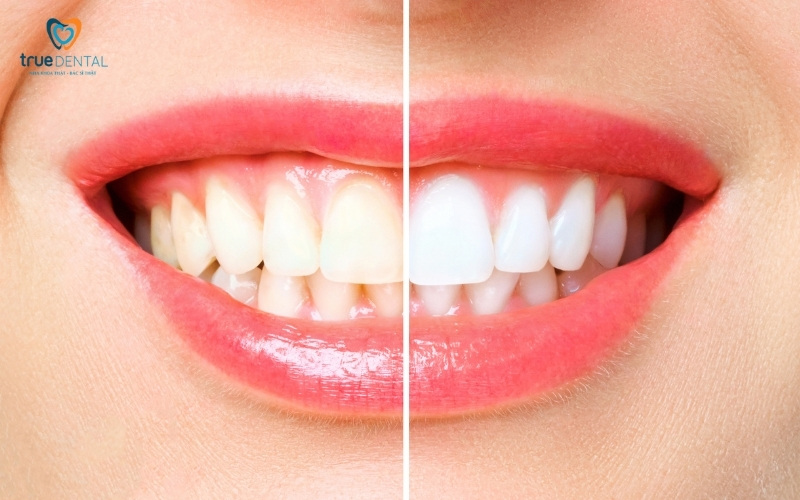 Có nên tẩy trắng răng không? Tẩy trắng răng có làm mòn men răng không? 2 Có nên tẩy trắng răng không