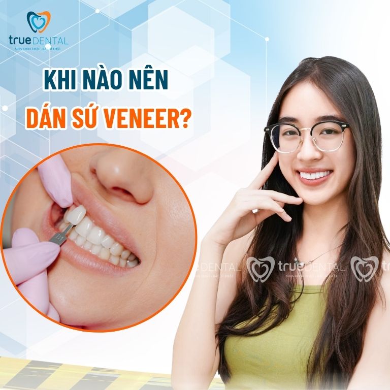 Khi nào thì nên dán sứ Veneer cho răng? 2 Khi nào nên dán sứ veneer?