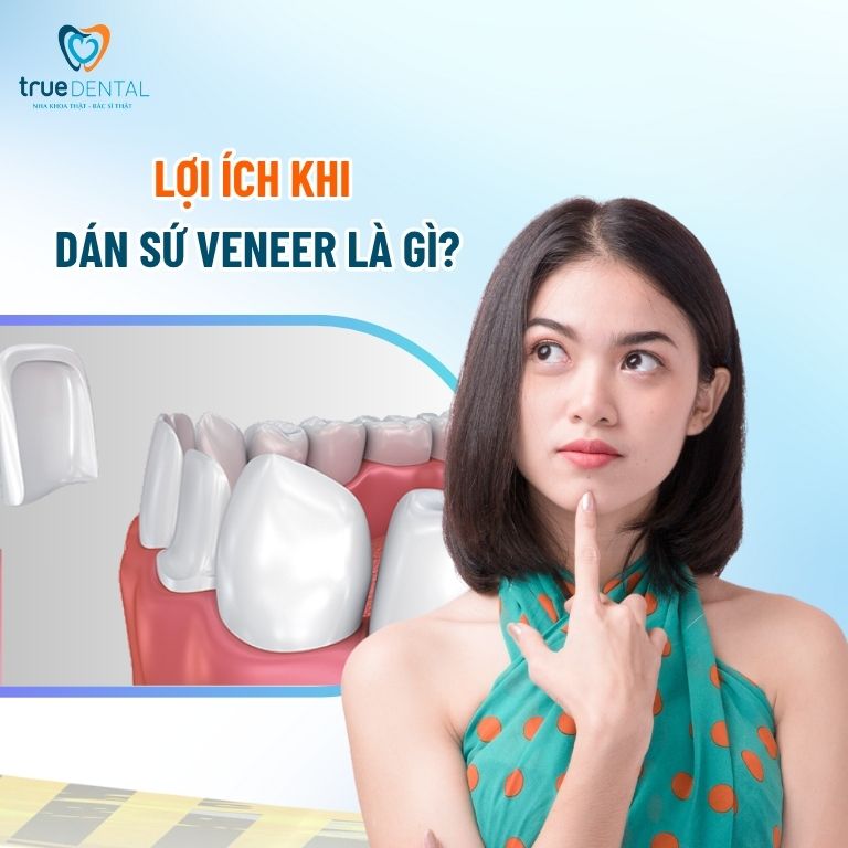 Khi nào thì nên dán sứ Veneer cho răng? 4 Lợi ích khi dán sứ Veneer