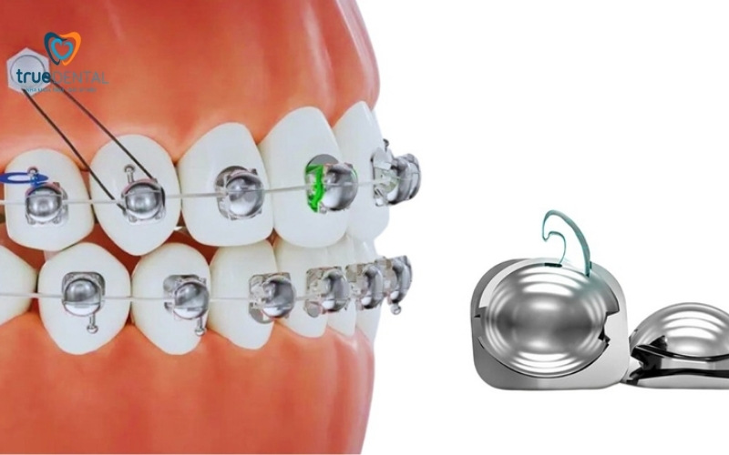 Mắc cài sứ được làm từ chất liệu gì? 4 Mắc cài sứ được làm từ chất liệu gì