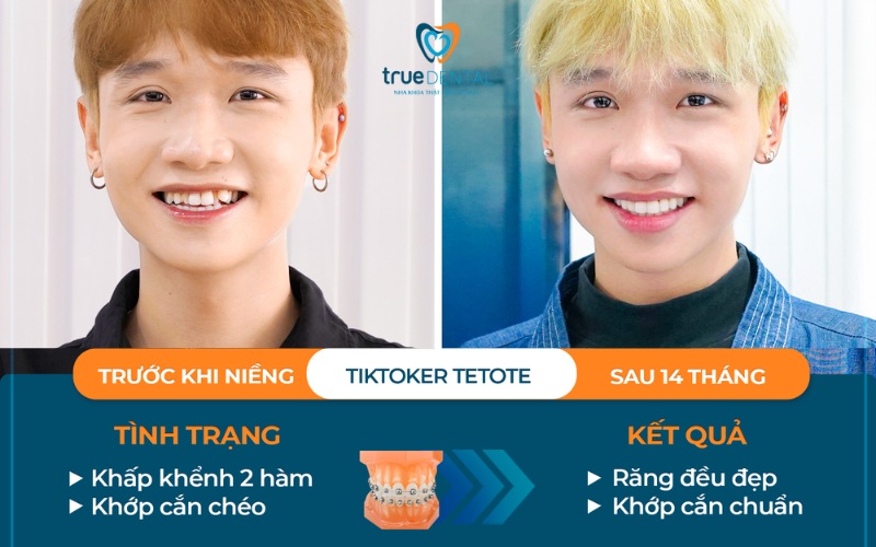 Mắc cài sứ được làm từ chất liệu gì? 5 Mắc cài sứ được làm từ chất liệu gì