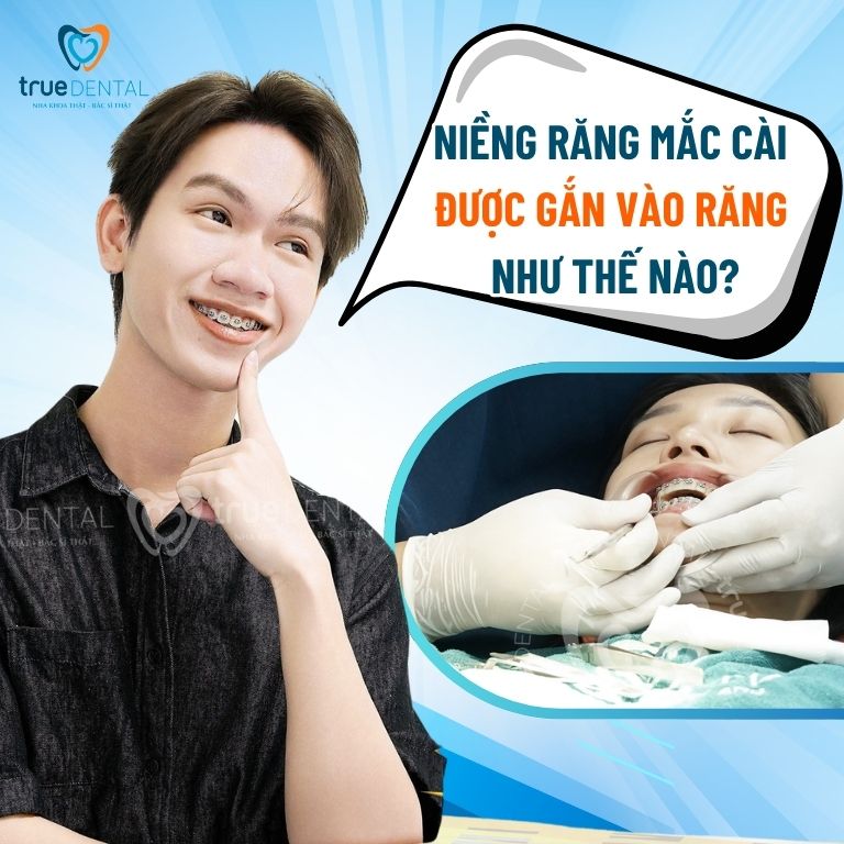 Niềng răng mắc cài được gắn vào răng như thế nào? 10 Niềng răng mắc cài được gắn vào răng như thế nào?